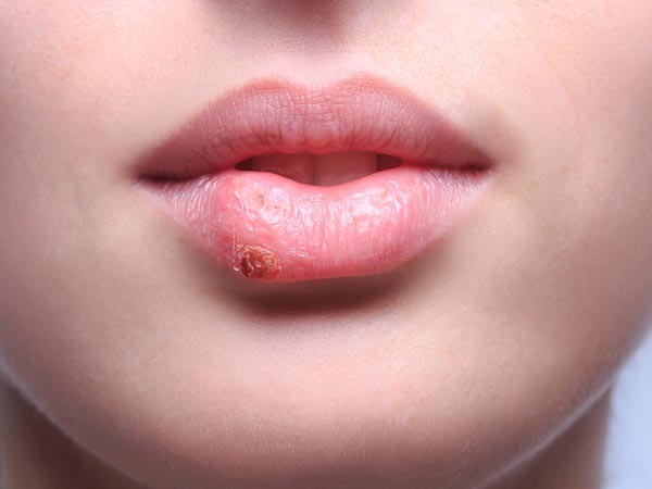 Lở môi: Các vết lở loét nhỏ trên môi thường là virus herpes gây ra và có thể lây từ người này qua người khác. Vì vậy, bạn không nên dùng chung son môi với những người có  triệu chứng bệnh này.